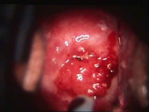 Как выглядит рак шейки матки